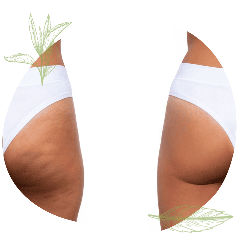 Mesoterapia para lipedema en Madrid