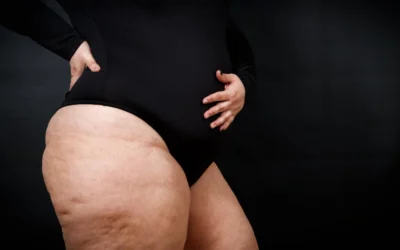 Inflamación silenciosa: lo que tu analítica puede revelar (y por qué es clave en el Lipedema)