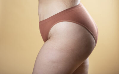 ¿Por qué es distinta la grasa en el lipedema?