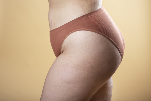 ¿Por qué es distinta la grasa en el lipedema?